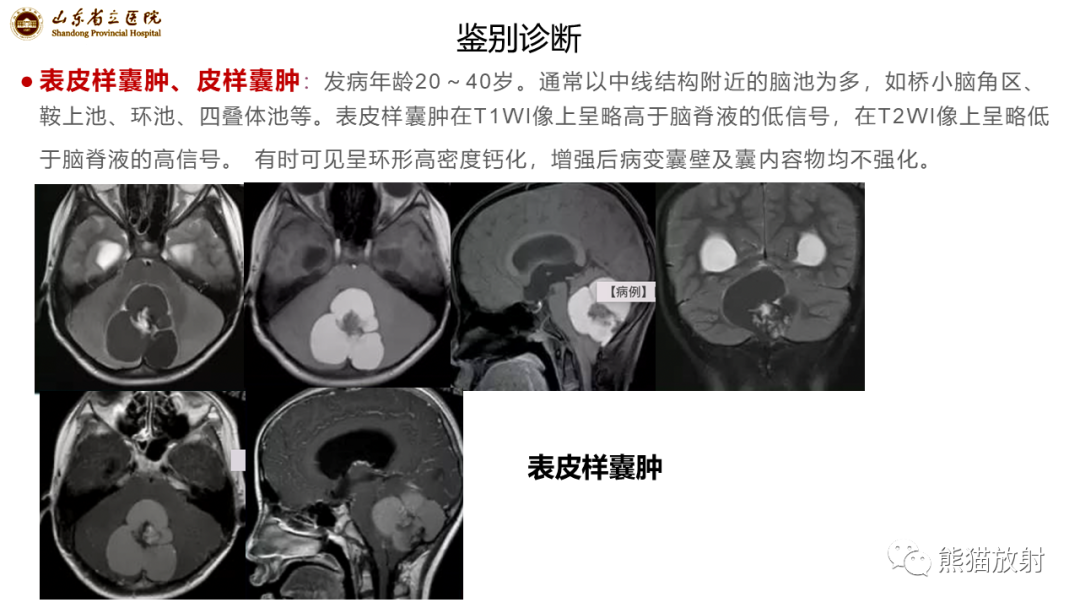 【病例】炎性肉芽肿并脓肿形成 & 成熟性囊性畸胎瘤-17