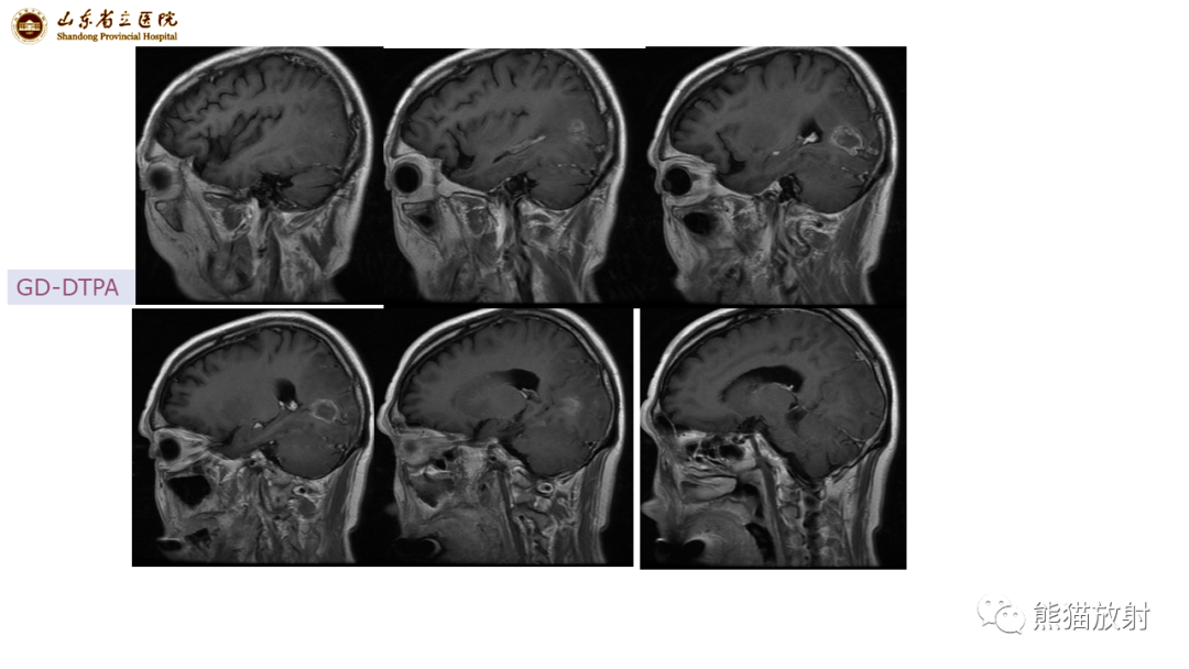 【病例】炎性肉芽肿并脓肿形成 & 成熟性囊性畸胎瘤-4