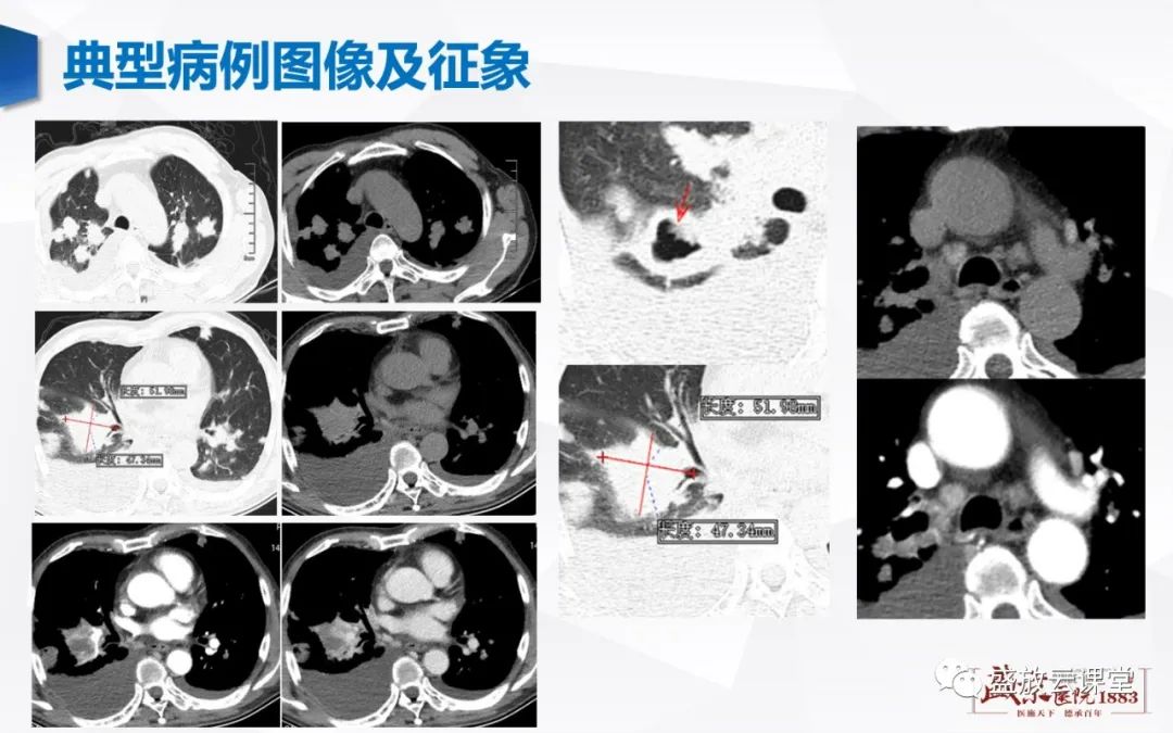 【病例】肺转移瘤1例CT影像-4