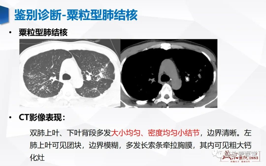 【病例】肺转移瘤1例CT影像-15