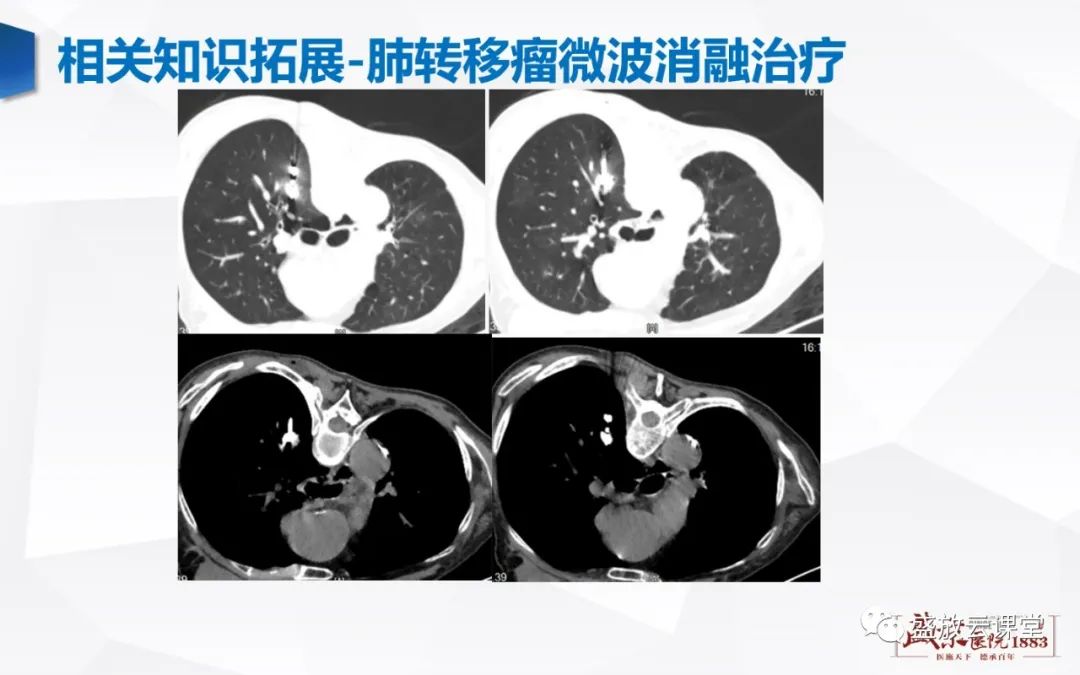 【病例】肺转移瘤1例CT影像-24