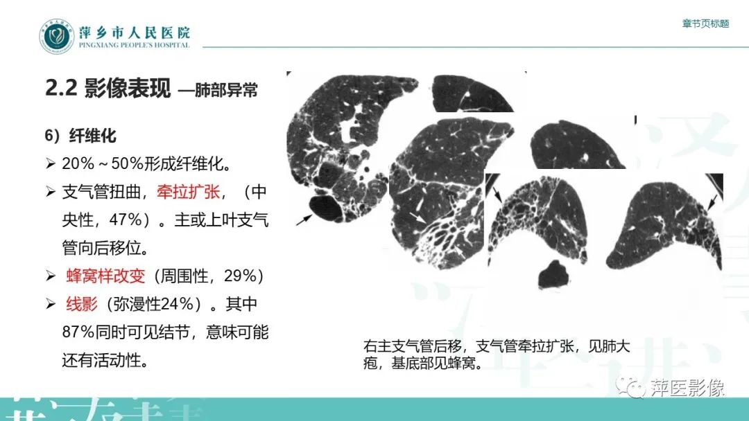 【PPT】肺结节病-16