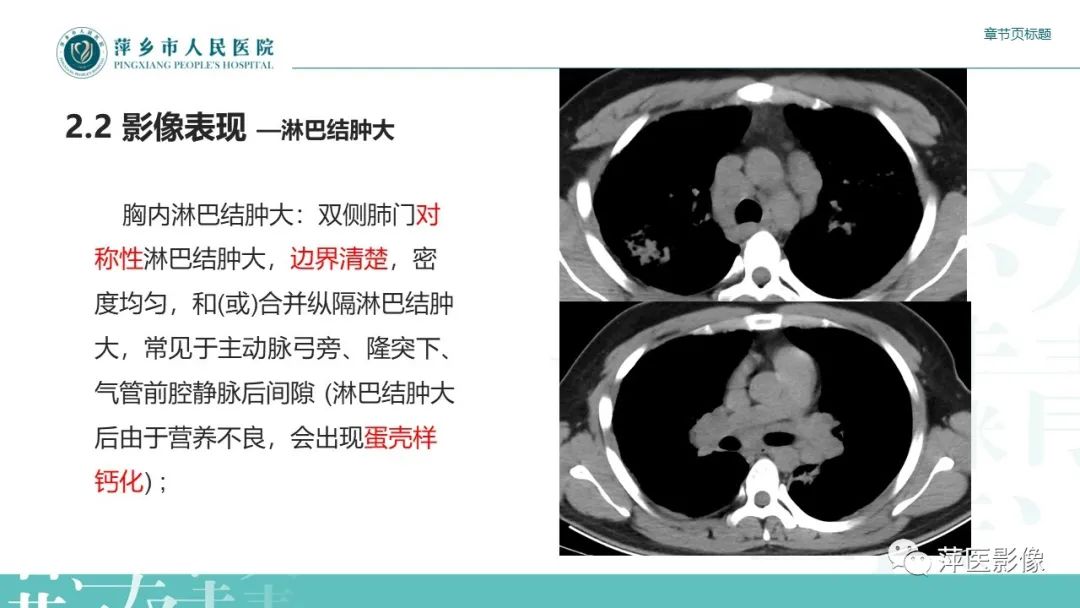 【PPT】肺结节病-9