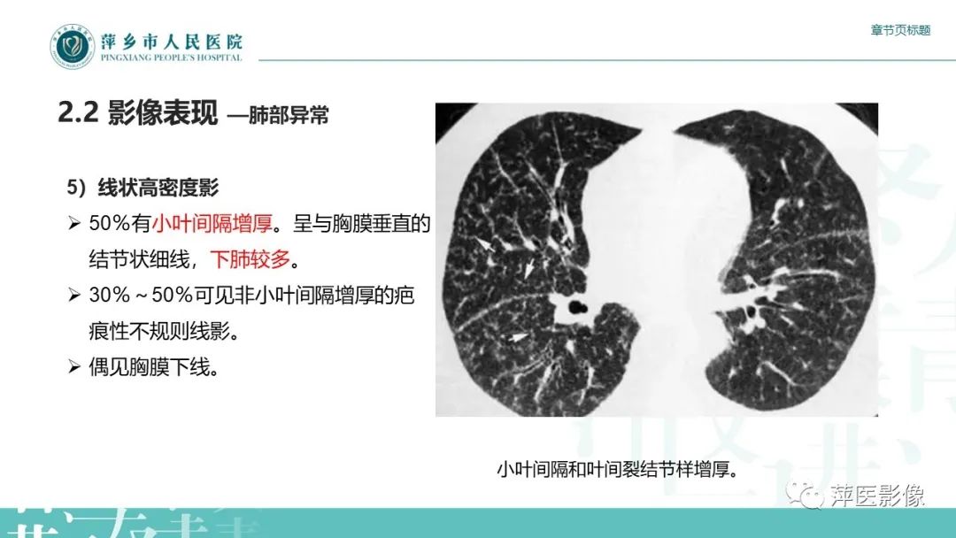 【PPT】肺结节病-15