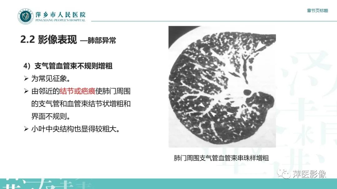 【PPT】肺结节病-14