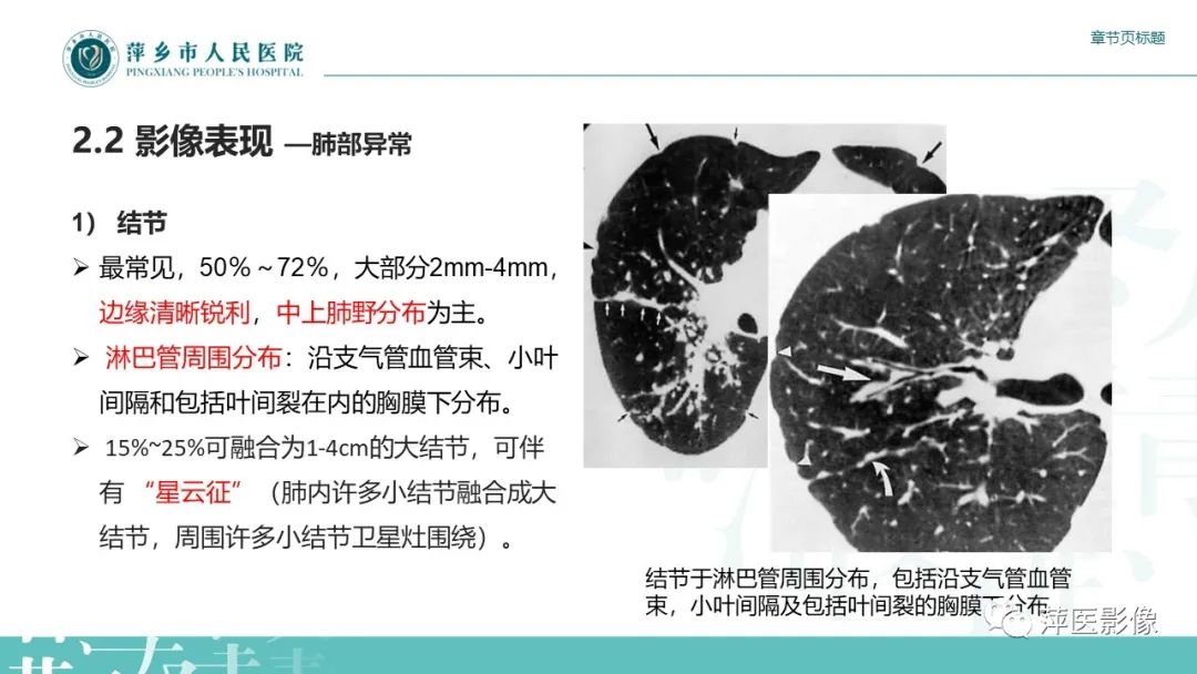 【PPT】肺结节病-11
