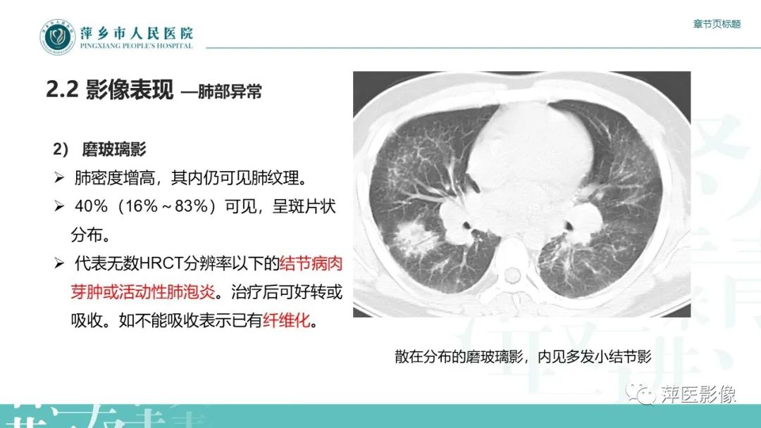【PPT】肺结节病-12