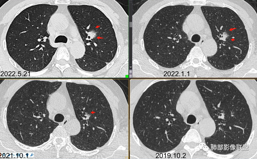 【病例】三年逐渐增大的混合磨玻璃结节，真相是什么？-19