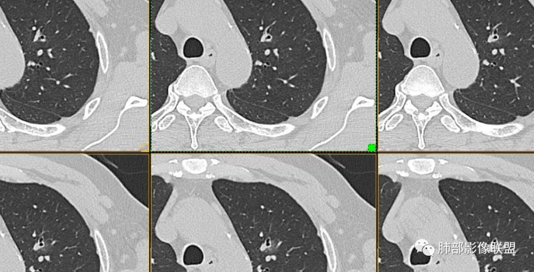 【病例】三年逐渐增大的混合磨玻璃结节，真相是什么？-28