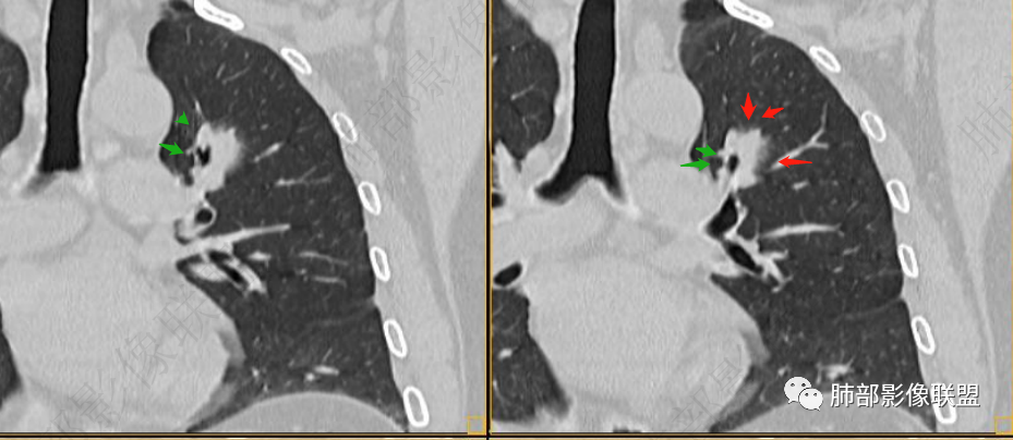【病例】三年逐渐增大的混合磨玻璃结节，真相是什么？-30