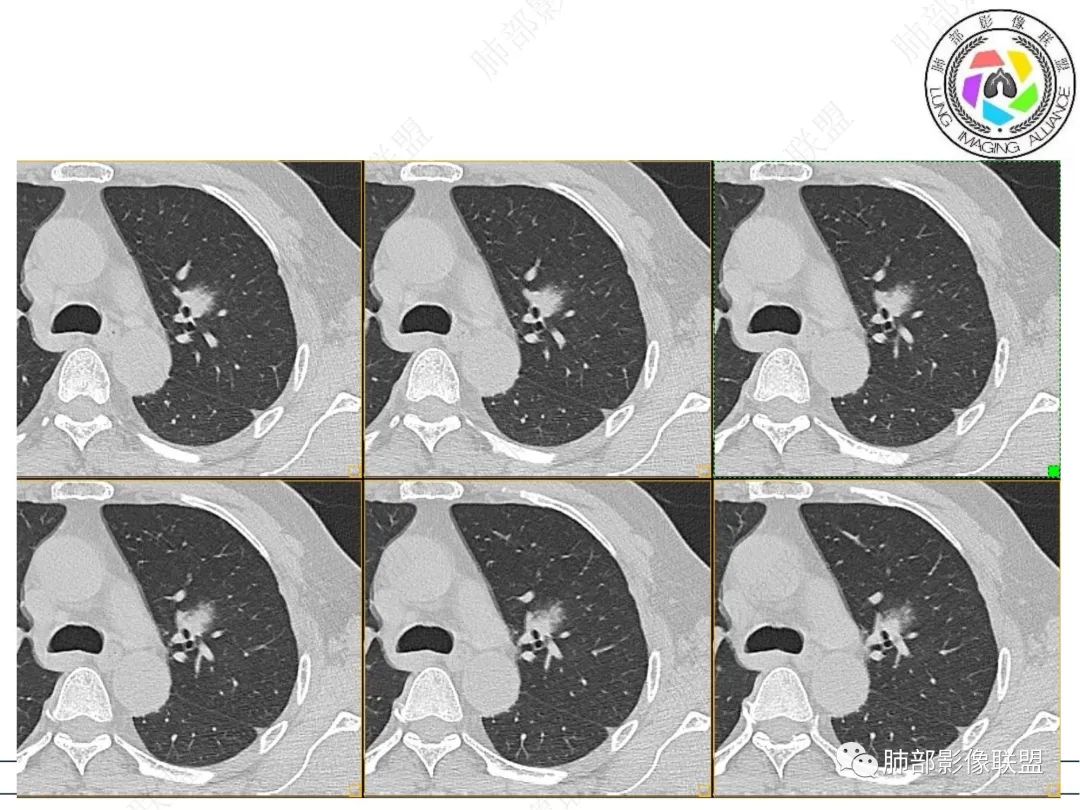 【病例】三年逐渐增大的混合磨玻璃结节，真相是什么？-8
