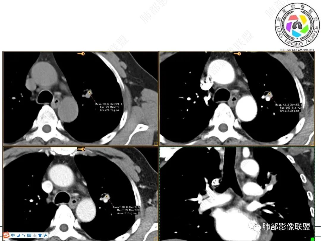 【病例】三年逐渐增大的混合磨玻璃结节，真相是什么？-12