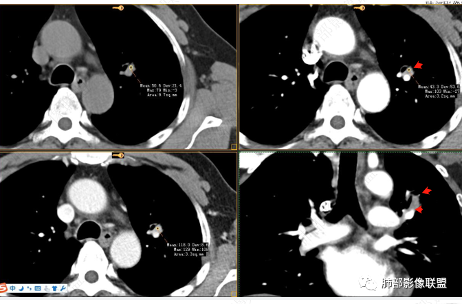 【病例】三年逐渐增大的混合磨玻璃结节，真相是什么？-24