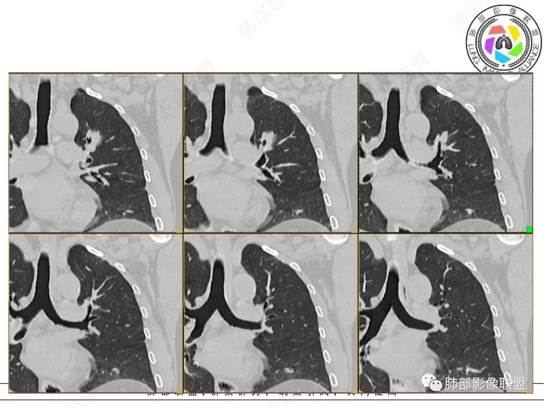 【病例】三年逐渐增大的混合磨玻璃结节，真相是什么？-11