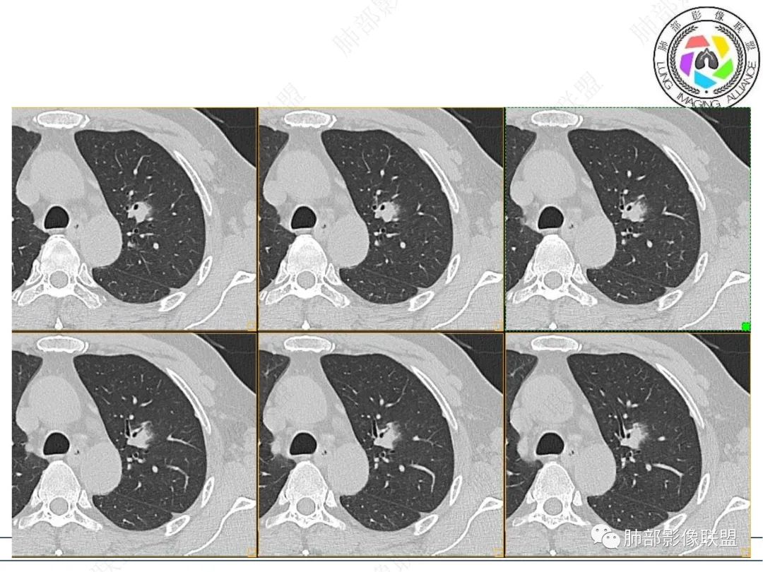 【病例】三年逐渐增大的混合磨玻璃结节，真相是什么？-6