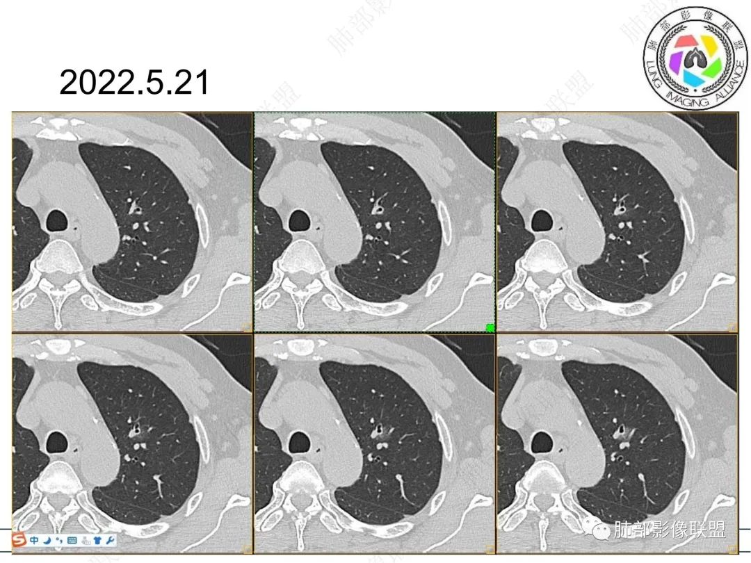【病例】三年逐渐增大的混合磨玻璃结节，真相是什么？-4
