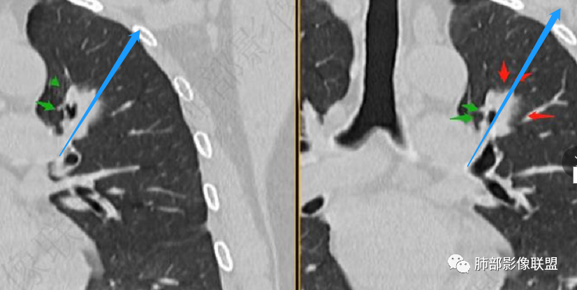 【病例】三年逐渐增大的混合磨玻璃结节，真相是什么？-32