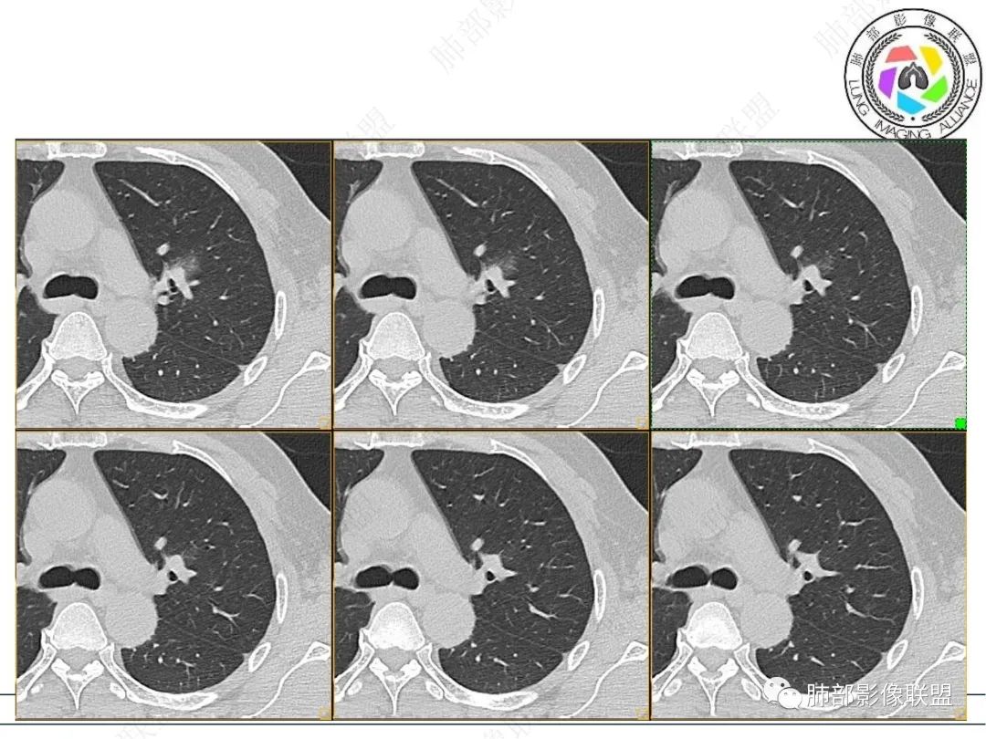 【病例】三年逐渐增大的混合磨玻璃结节，真相是什么？-9