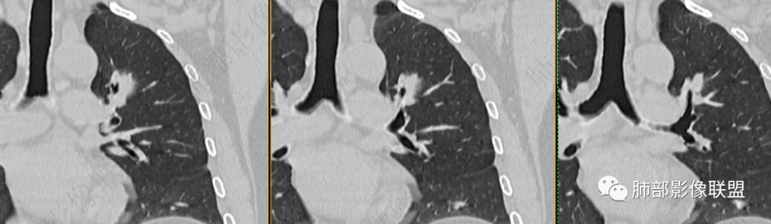 【病例】三年逐渐增大的混合磨玻璃结节，真相是什么？-29