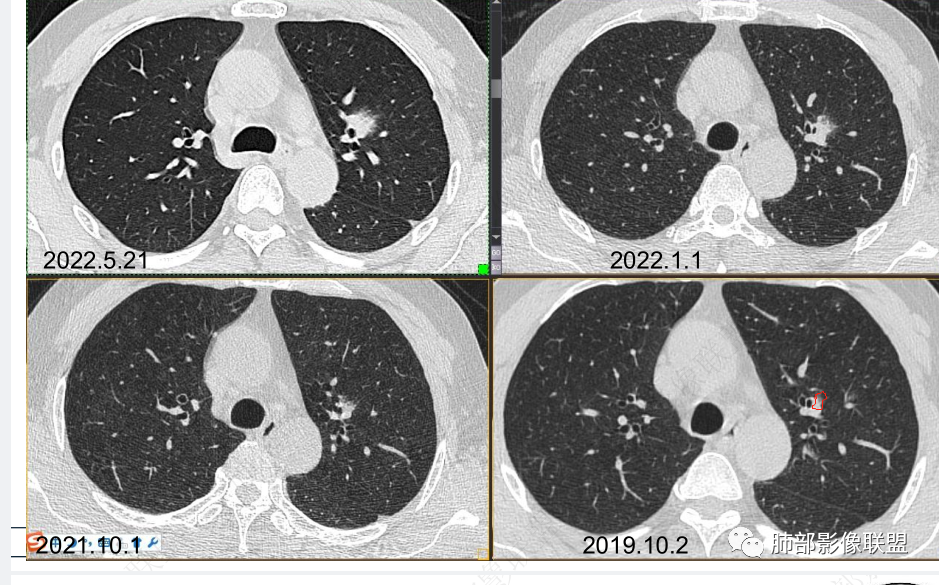 【病例】三年逐渐增大的混合磨玻璃结节，真相是什么？-18
