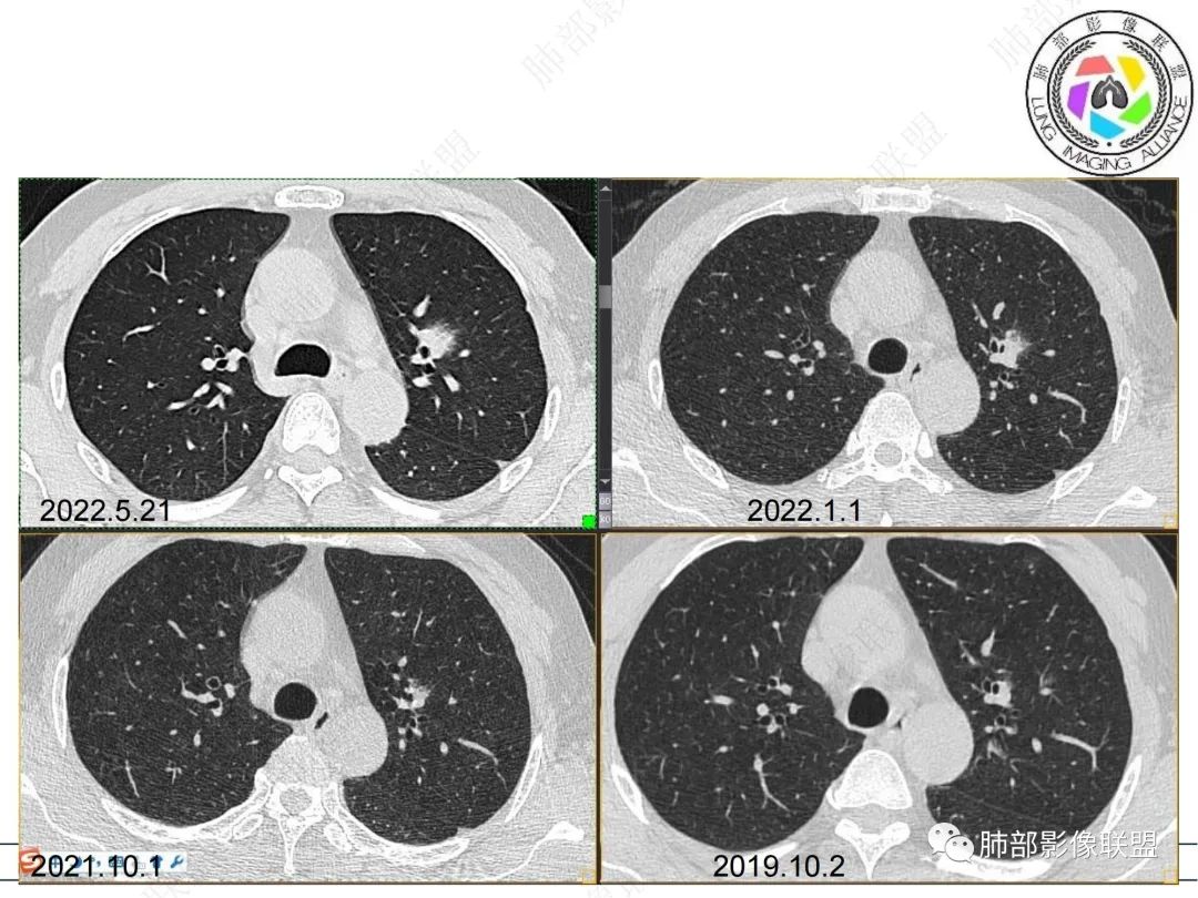 【病例】三年逐渐增大的混合磨玻璃结节，真相是什么？-3