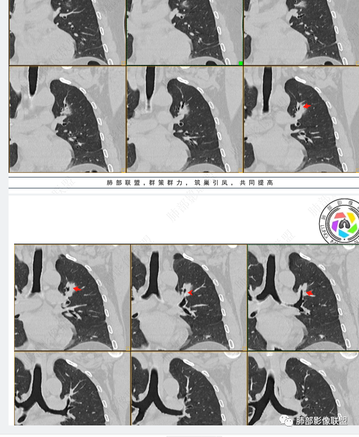 【病例】三年逐渐增大的混合磨玻璃结节，真相是什么？-23
