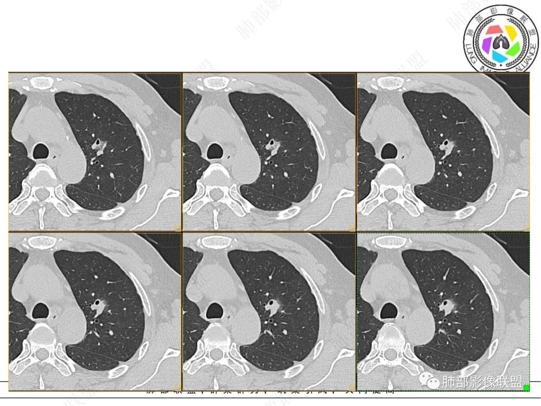 【病例】三年逐渐增大的混合磨玻璃结节，真相是什么？-5