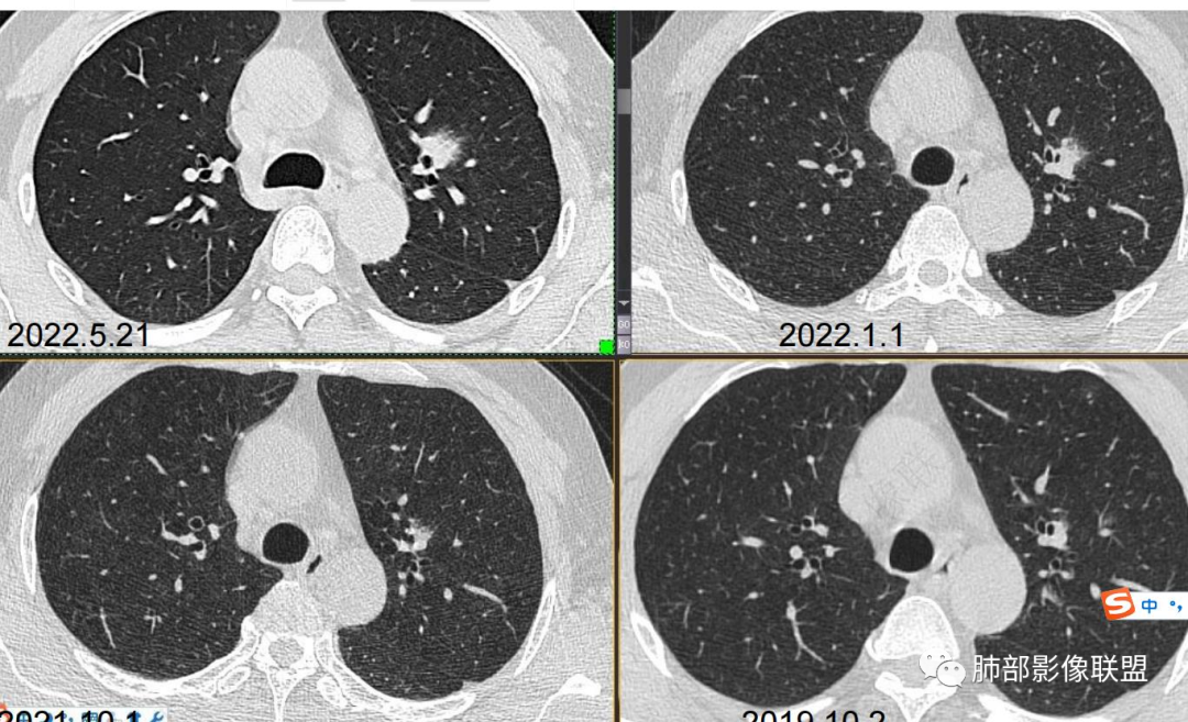 【病例】三年逐渐增大的混合磨玻璃结节，真相是什么？-27