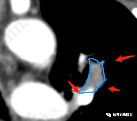 【病例】三年逐渐增大的混合磨玻璃结节，真相是什么？-33