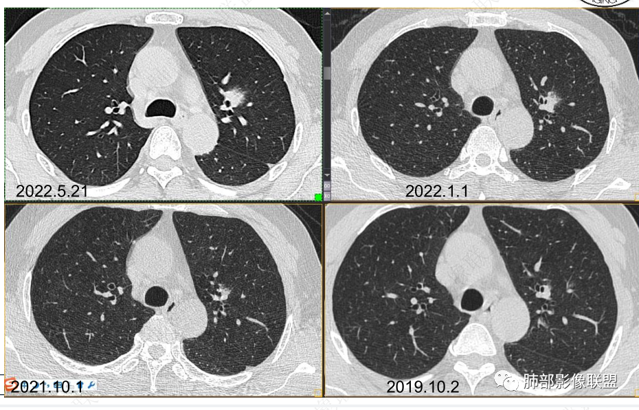 【病例】三年逐渐增大的混合磨玻璃结节，真相是什么？-17