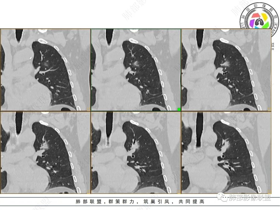 【病例】三年逐渐增大的混合磨玻璃结节，真相是什么？-10