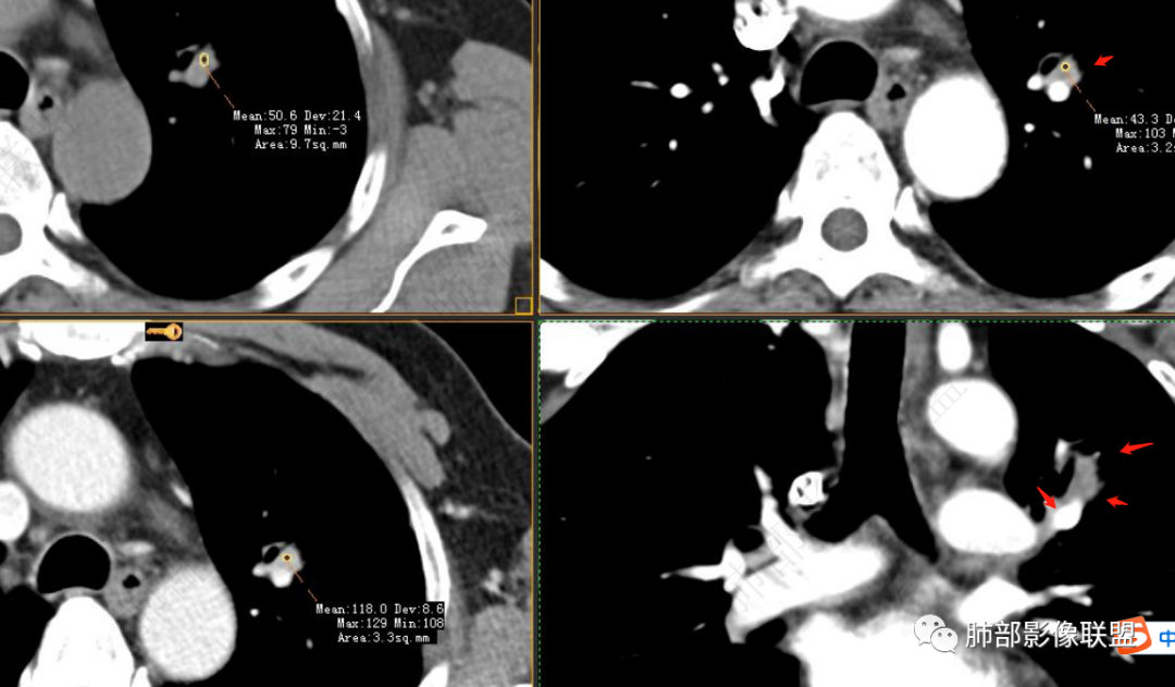 【病例】三年逐渐增大的混合磨玻璃结节，真相是什么？-31