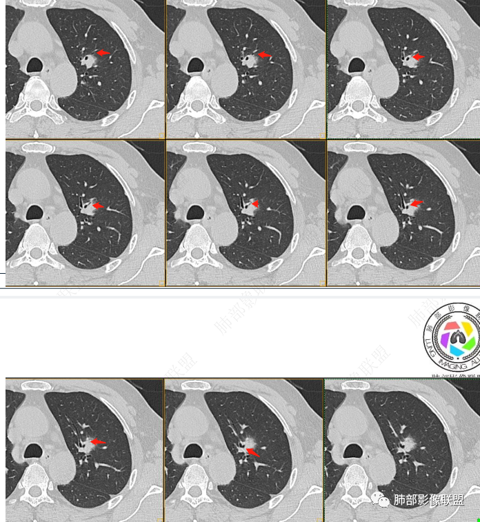 【病例】三年逐渐增大的混合磨玻璃结节，真相是什么？-22