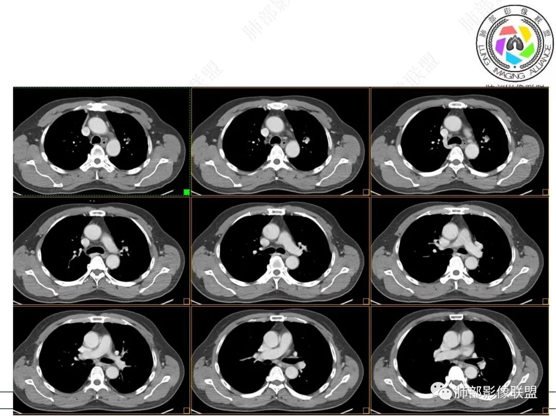 【病例】三年逐渐增大的混合磨玻璃结节，真相是什么？-13