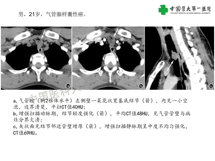 【病例】气管腺样囊性癌1例CT影像-15