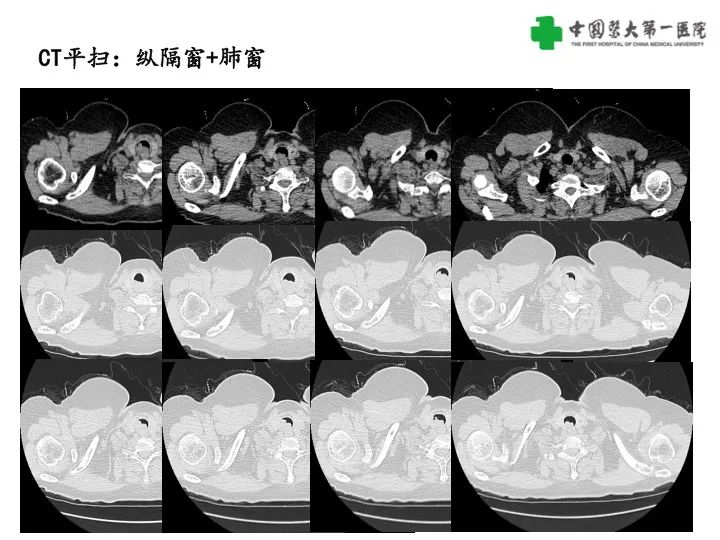 【病例】气管腺样囊性癌1例CT影像-3