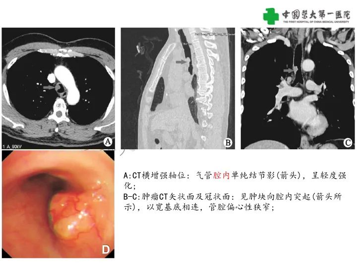 【病例】气管腺样囊性癌1例CT影像-14