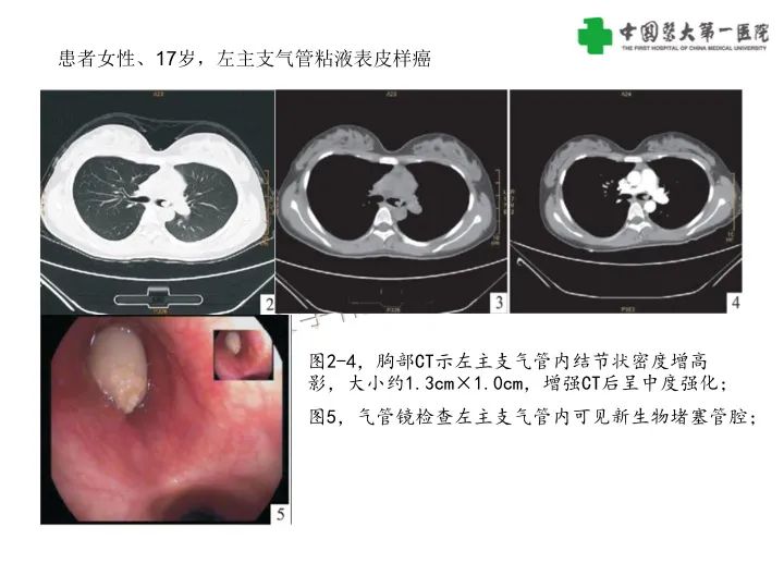 【病例】气管腺样囊性癌1例CT影像-29