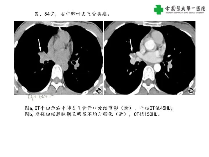 【病例】气管腺样囊性癌1例CT影像-23
