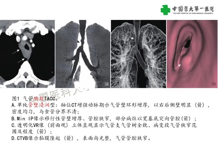 【病例】气管腺样囊性癌1例CT影像-12