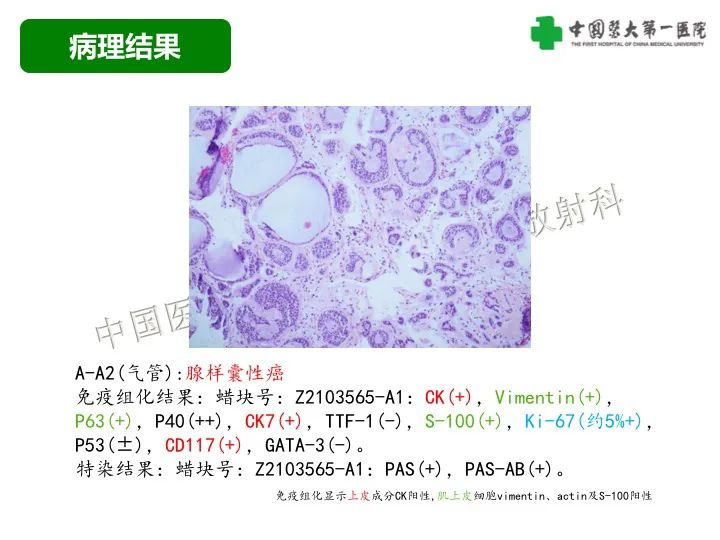 【病例】气管腺样囊性癌1例CT影像-7