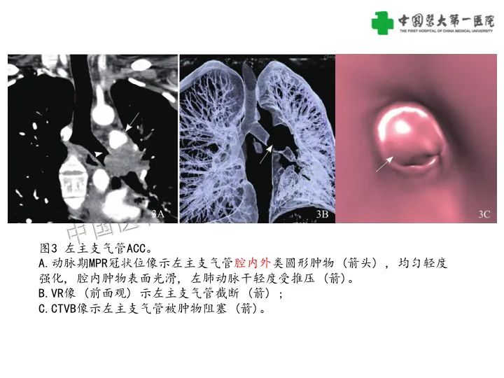 【病例】气管腺样囊性癌1例CT影像-13