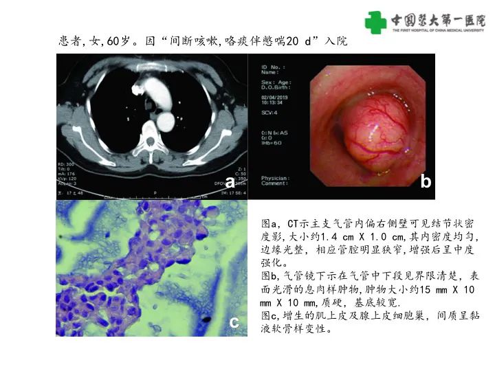 【病例】气管腺样囊性癌1例CT影像-19