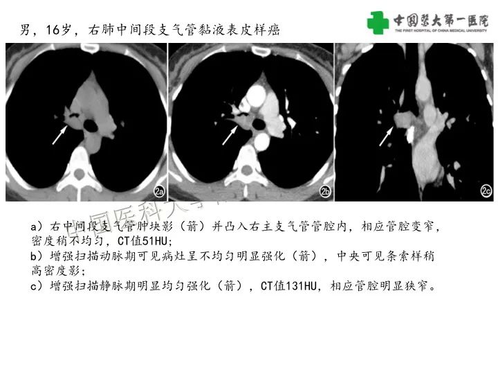 【病例】气管腺样囊性癌1例CT影像-28