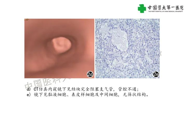 【病例】气管腺样囊性癌1例CT影像-27