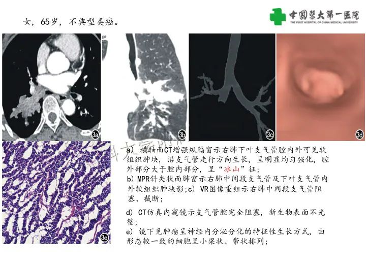 【病例】气管腺样囊性癌1例CT影像-22