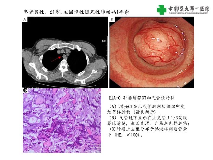 【病例】气管腺样囊性癌1例CT影像-20