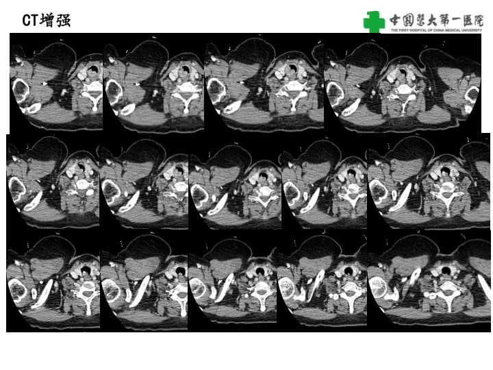 【病例】气管腺样囊性癌1例CT影像-4