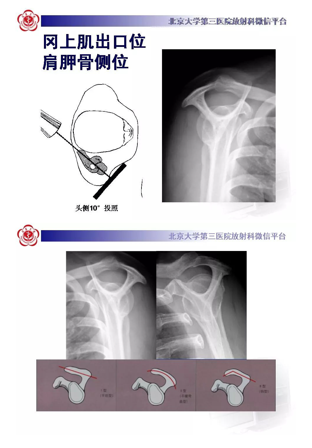 【PPT】肩袖疾病的X线检查及诊断-6