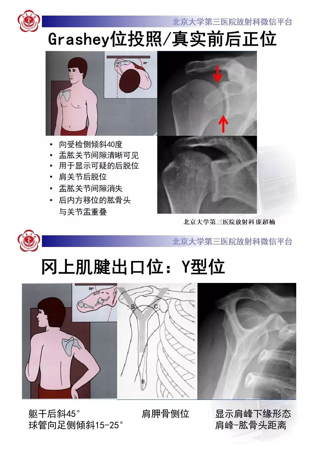 【PPT】肩袖疾病的X线检查及诊断-2